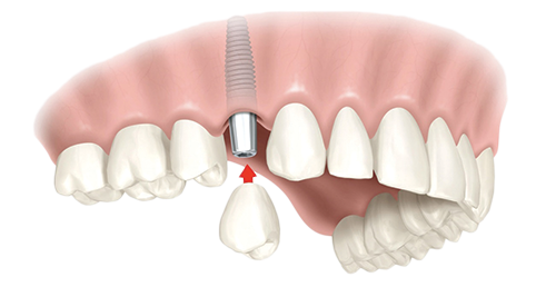 Single Dental Implants Clinton Township